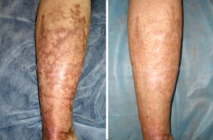 Ожоговые шрамы до и после лечения