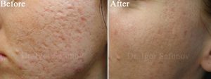 Improving of atrophic acne scars[:sv]Borttagning av atrofiska acneärr