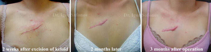 Återfall av keloid på bröstet efter kirurgisk behandling