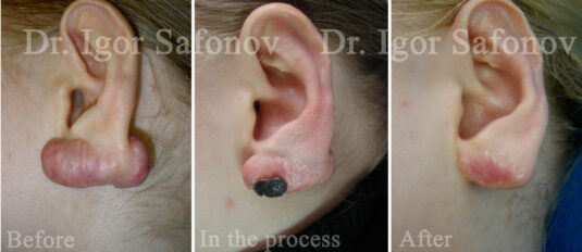 Keloid i örat före, under och efter kryobehandling