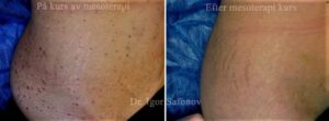 Mesotherapy for old stretch marks