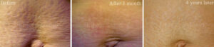 Old stretch marks on the abdomen before and after TCA peel correction