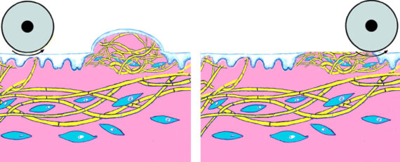Roterande dermabrasion av ett hypertrofiskt ärr
