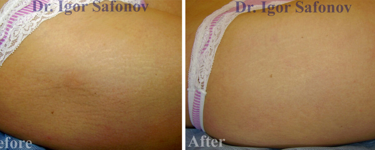 STRETCH MARKS (STRIAE) Treatment and Correction - Scarshelper