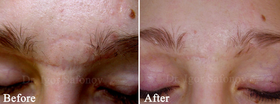 slipning av atrofiska ärr i ansiktet med djup kirurgisk dermabrasion (foton före och efter )