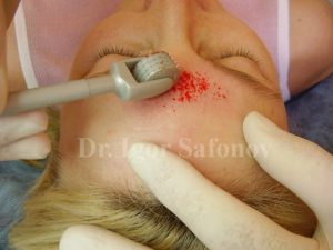 Behandling av acneärr med microneedling