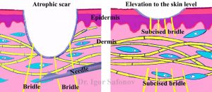 Schematisk bild av subcision