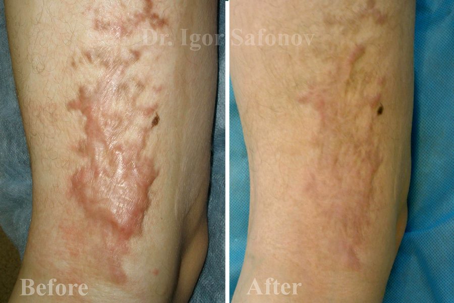 Image result for microneedling for burn scars