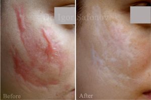 Treatment of keloids and hypertrophic scars on the face