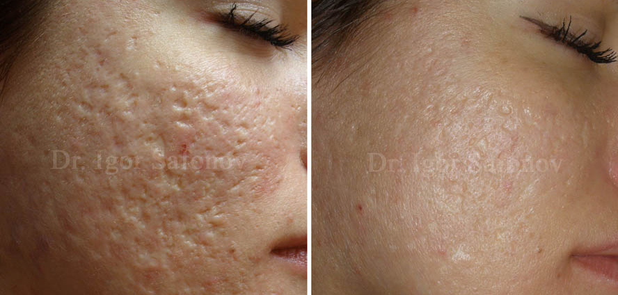 Analysis and examples of all methods of treatment for atrophic acne scars and scars after accidents, surgeries, etc. Atrophic scars and acne scars before and after treatment