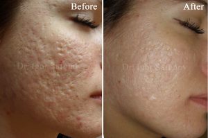 microneedling behandling mot acneärr gropar i ansiktet (före och efter)