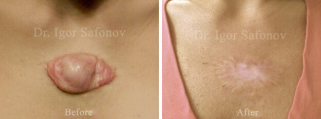 Bröstkeloid före och efter kryobehandling