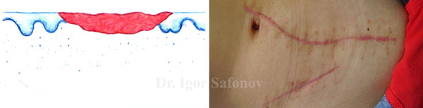 normotrophic scar