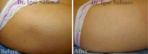 Stretch mark treatment with microneedling.