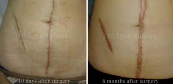 Transformation of normotrophic scars to hypertrophic scars
