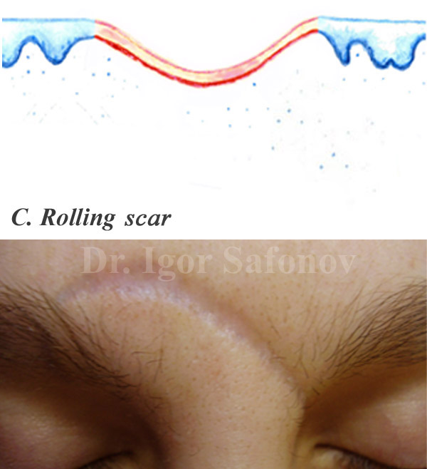 Атрофические ладьевидные рубцы (rolling scar)