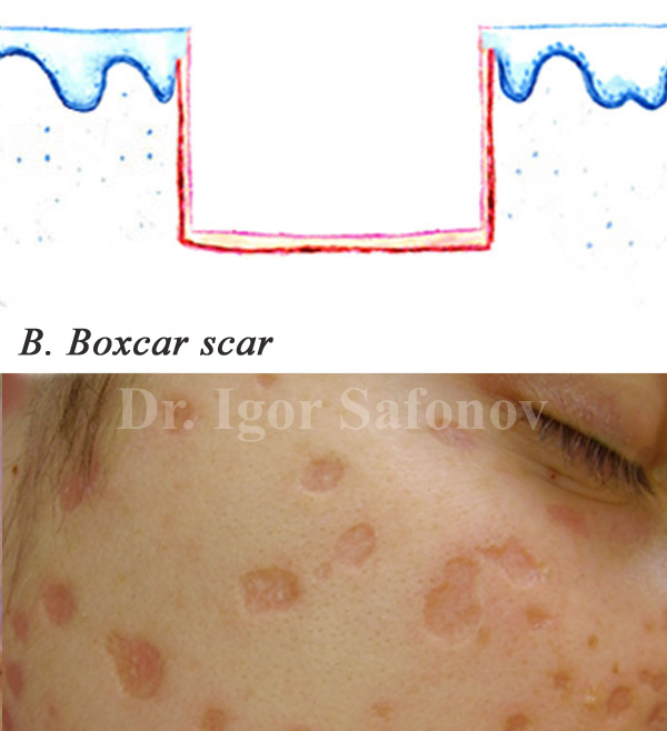Атрофические прямоугольные рубцы (boxcar scar)