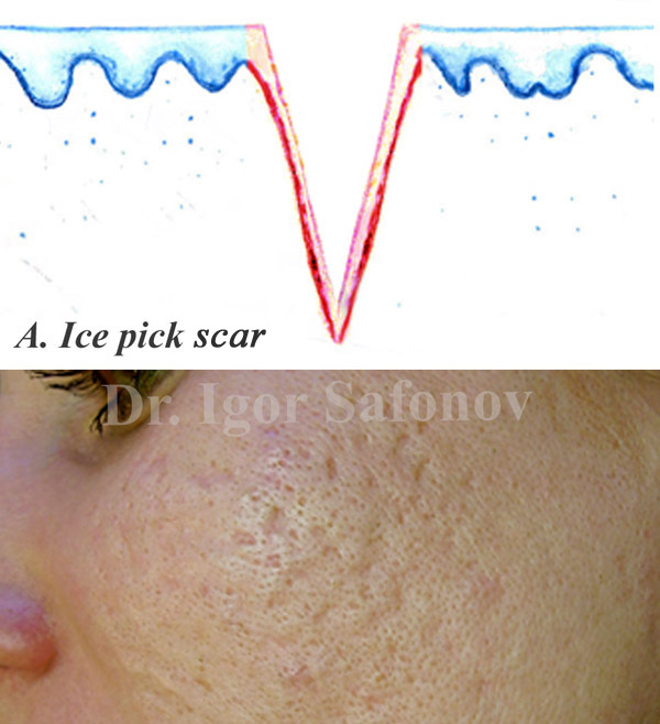 Сколотые рубцы (ice pick scar)