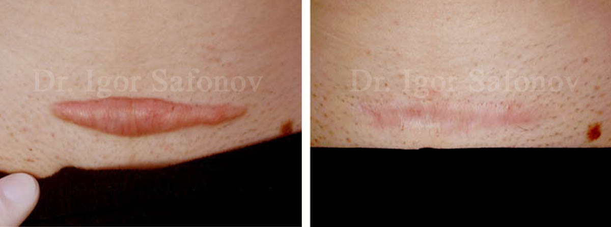 Hypertrophic C-Section scar before and after treatment