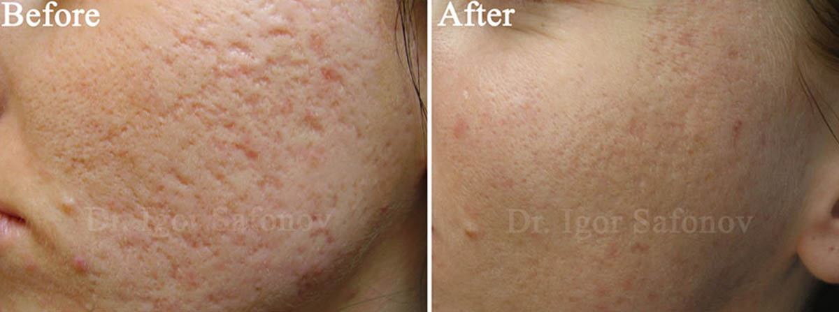 Improving of atrophic acne scars