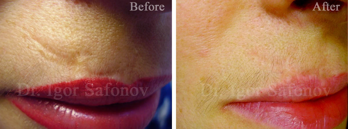 Correction of the old scar after injury on the upper lip