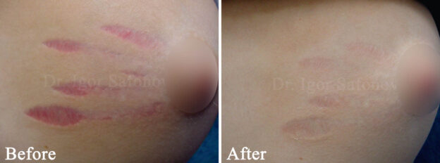 Laser treatment (PDL) of fresh stretch marks on the breasts