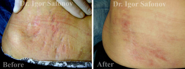 Old stretch marks before and after TCA peeling