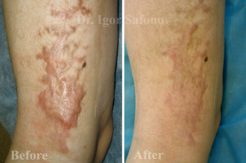Treatment hypertrophic scars and keloider with microneedling (burn scars before and after)