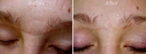 Ärr efter skada i pannan och på näsryggen före och efter dermabrasion