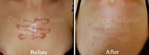 chest keloids