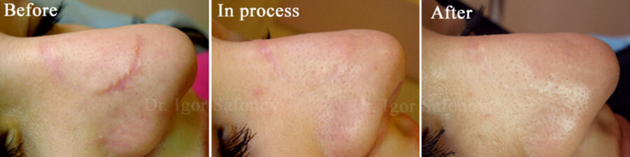 hydration of normotrophic scar before and after treatment