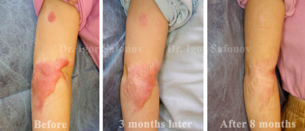 [:en]Fig.2. Post burn keloid treatment with silicone sheeting. Photos before and after [:]