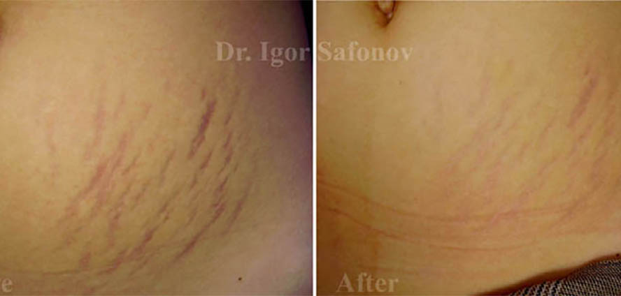 methods of stretch mark removal, surgical methods of removing stretch marks, surgical excision of stretch marks, abdominoplasty for stretch marks, mesotherapy stretch marks before after, microdermabrasion for stretch marks, stretch marks on the hips, chemical peels for stretch marks, laser for stretch marks, vascular lasers for red stretch marks before and after, stretch marks on the breast before after  