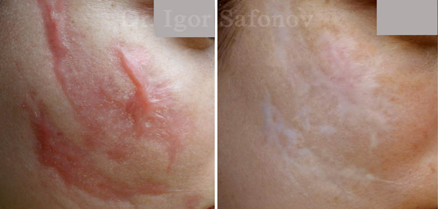Choice of keloid treatment according to the localization: removal earlap keloid,  removal chest keloid, treatment hypertrophic C-Section scar, post-burn keloids treatment. Keloid and Hypertrophic scars before and after treatment