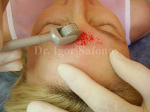 Microneedling treatment for scars
