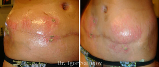 Abdominal stretch marks after tummy tuck and TCA peeling