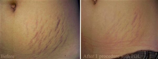 Treatment of stretch marks with laser on the abdomen before and after