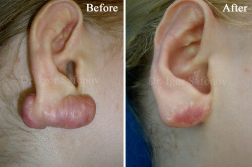 removal of earlobe keloids with liquid nitrogen (before and after photos)