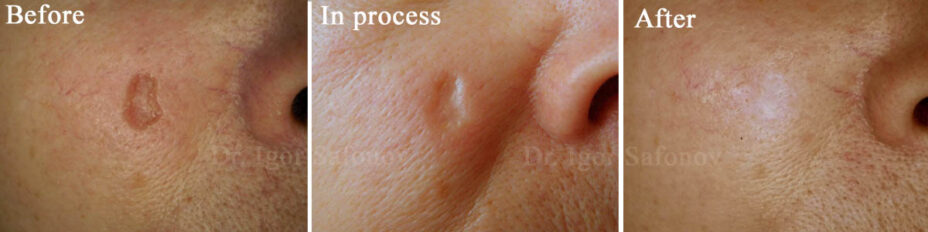 microdermabrasion av ett atrofiskt ärr i ansiktet före, under och efter behandlingen
