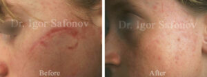 hypervascularised scar on left cheek before and after PDL laser treatment