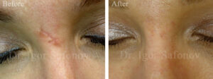 fresh atrophic scar on the nose bridge before and after treatment