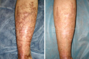 old post-burn scars