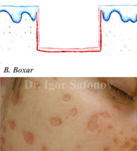 Atrophic boxcar scars on tha face