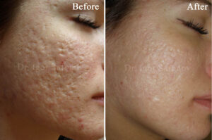 Correction of atrophic acne scars on the face