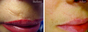 an old atrophic scar on the face before and after correction