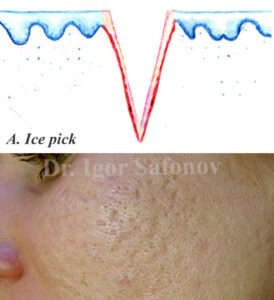 atrophic ice pick scars